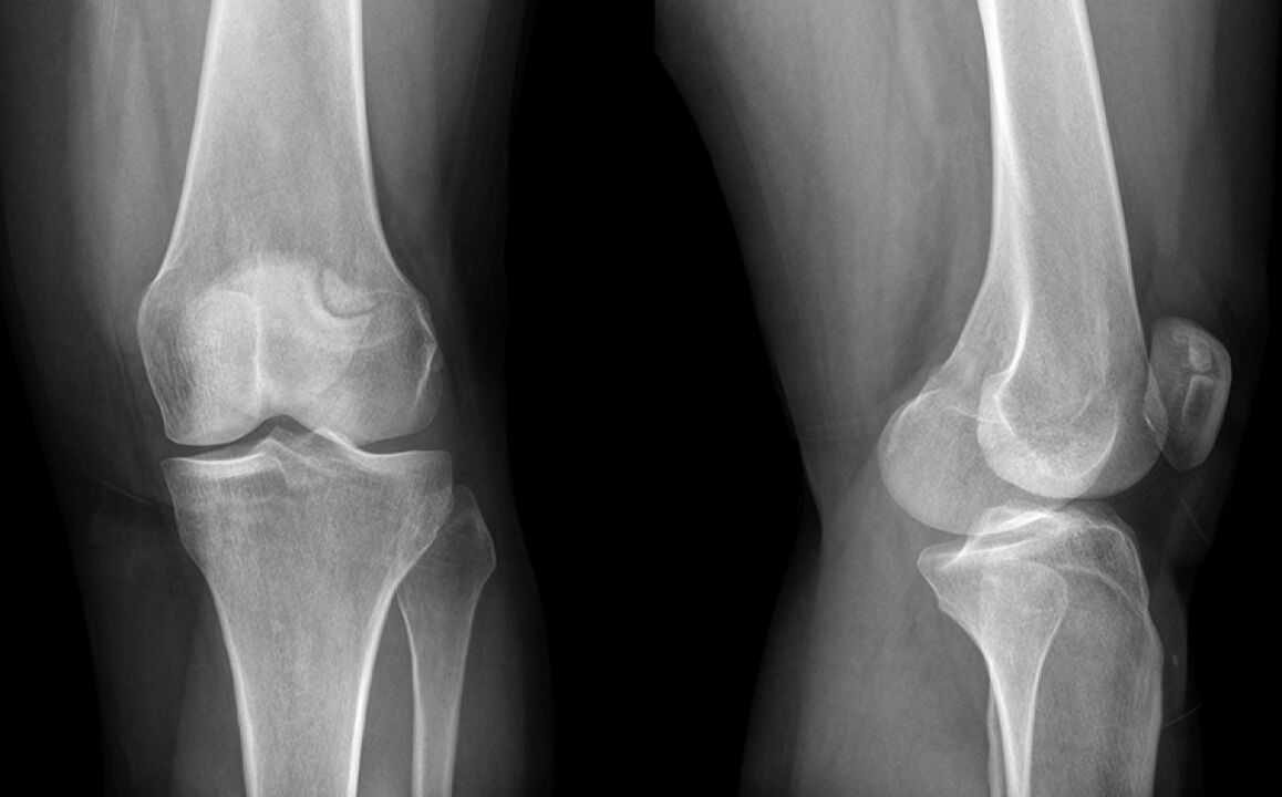 A osteoartrite do xeonllo nos raios X antes de usar Hondroine