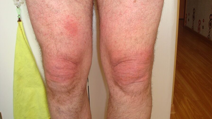 Artrose das articulacións do xeonllo