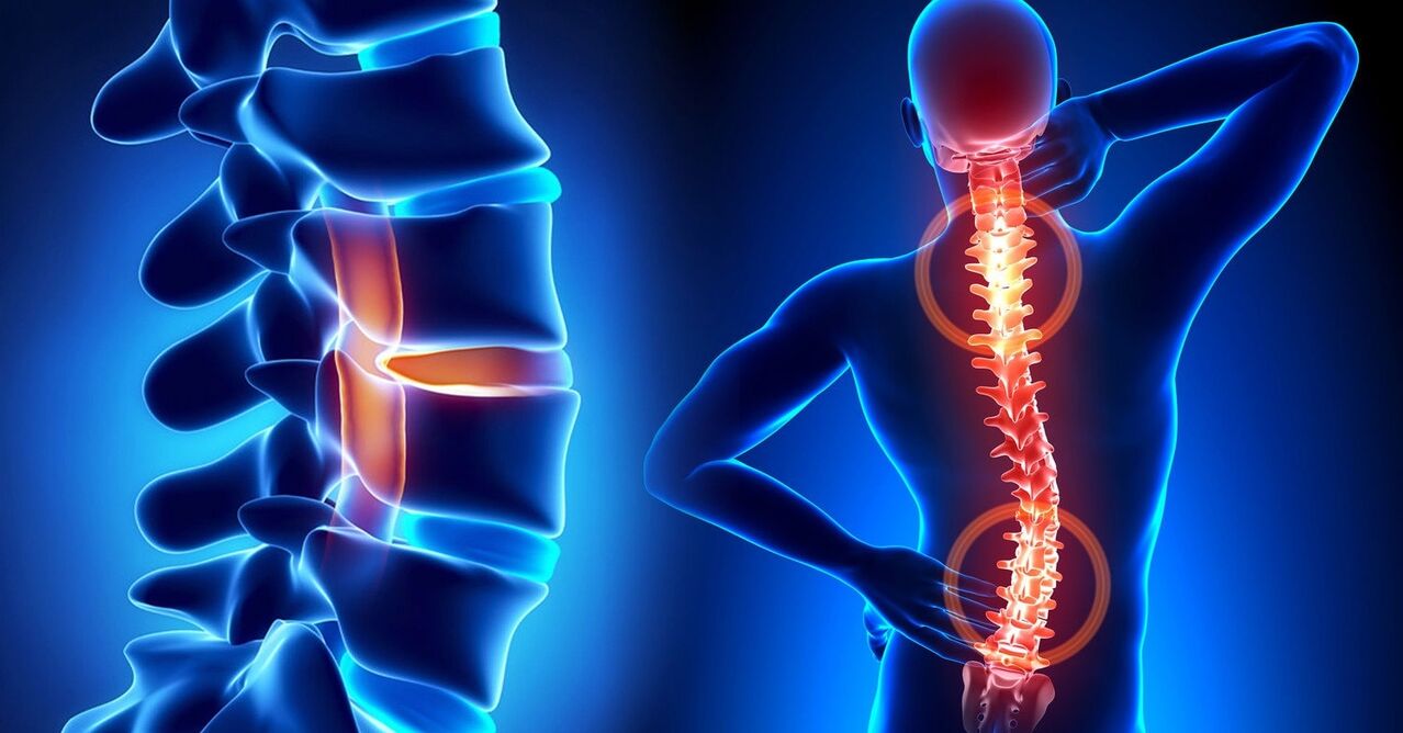 Dor na columna vertebral debido á osteocondrose